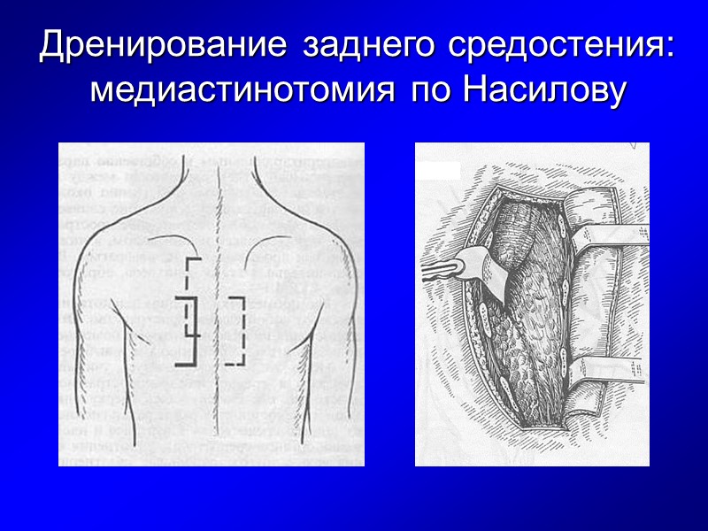 Дренирование заднего средостения:  медиастинотомия по Насилову